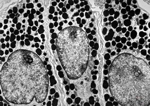 M, 12y. | urticaria pigmentosa M, 12y. | urticaria pigmentosa